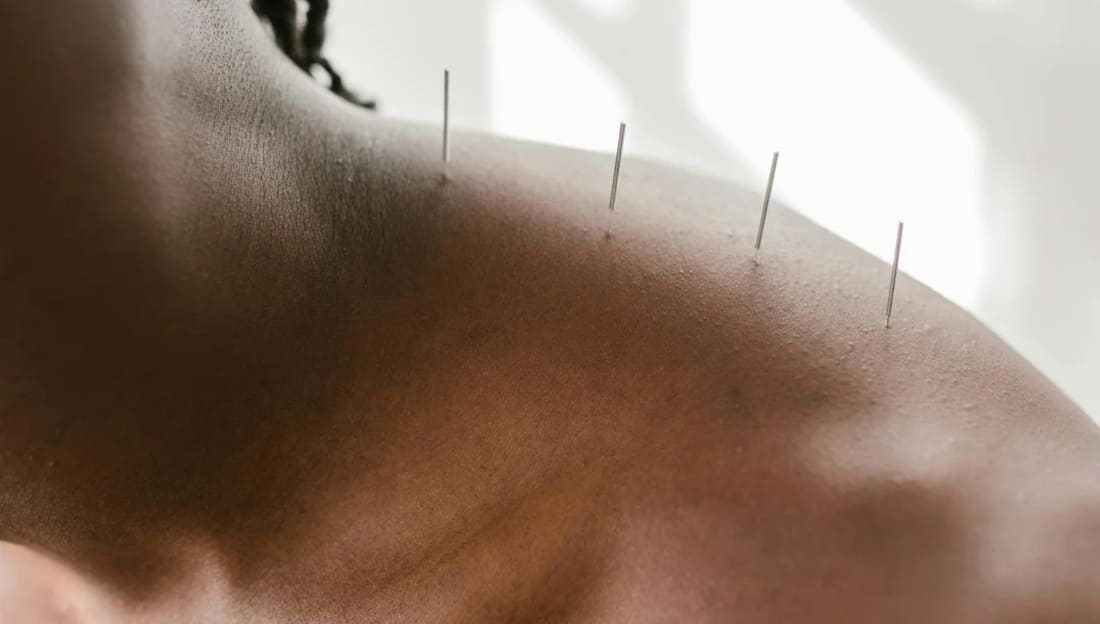 What's the Difference Between Dry Needling and Acupuncture?