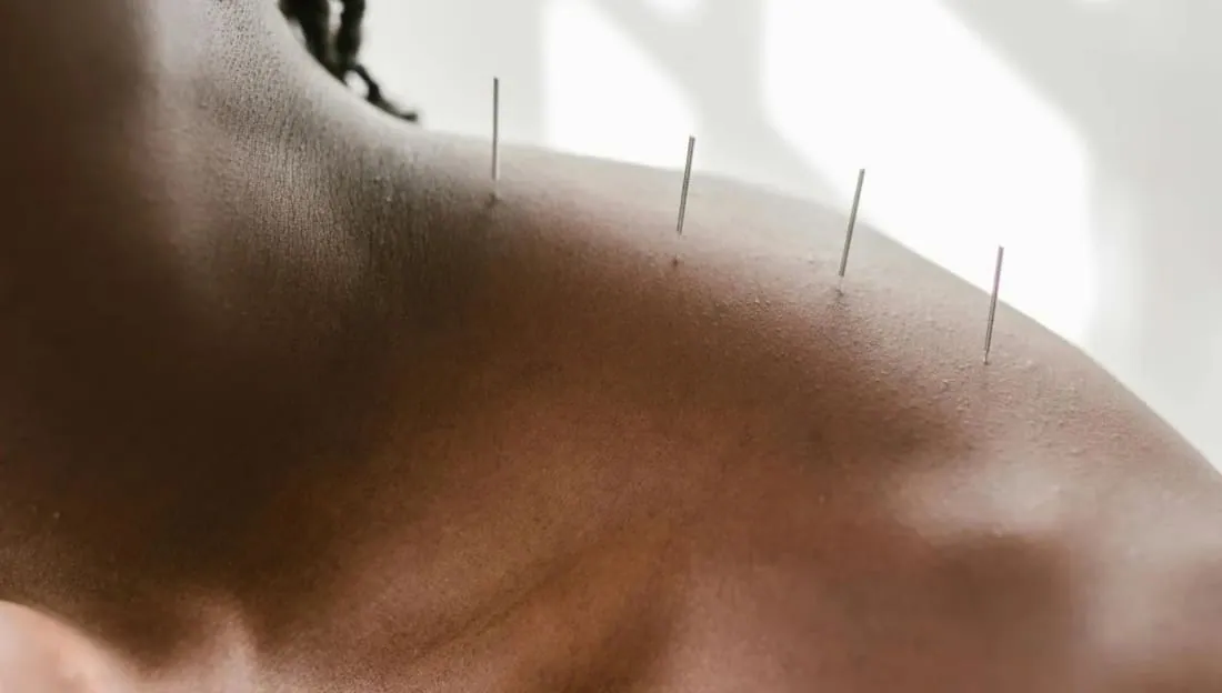 What's the Difference Between Dry Needling and Acupuncture?