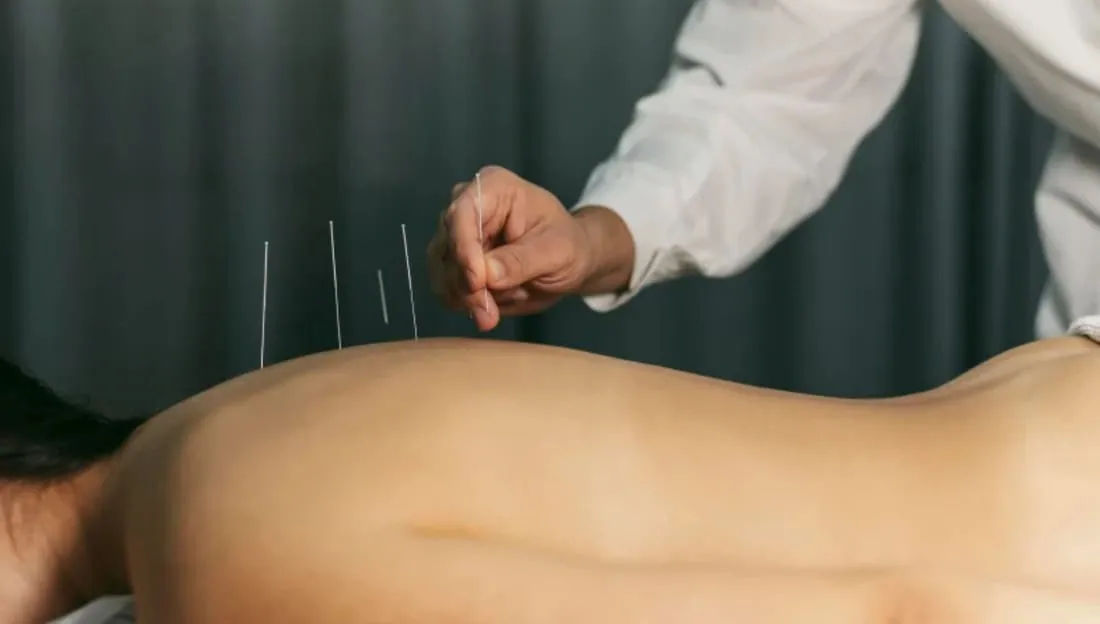 The Ultimate Guide to Dry Needling: What It Is + How You Can Benefit