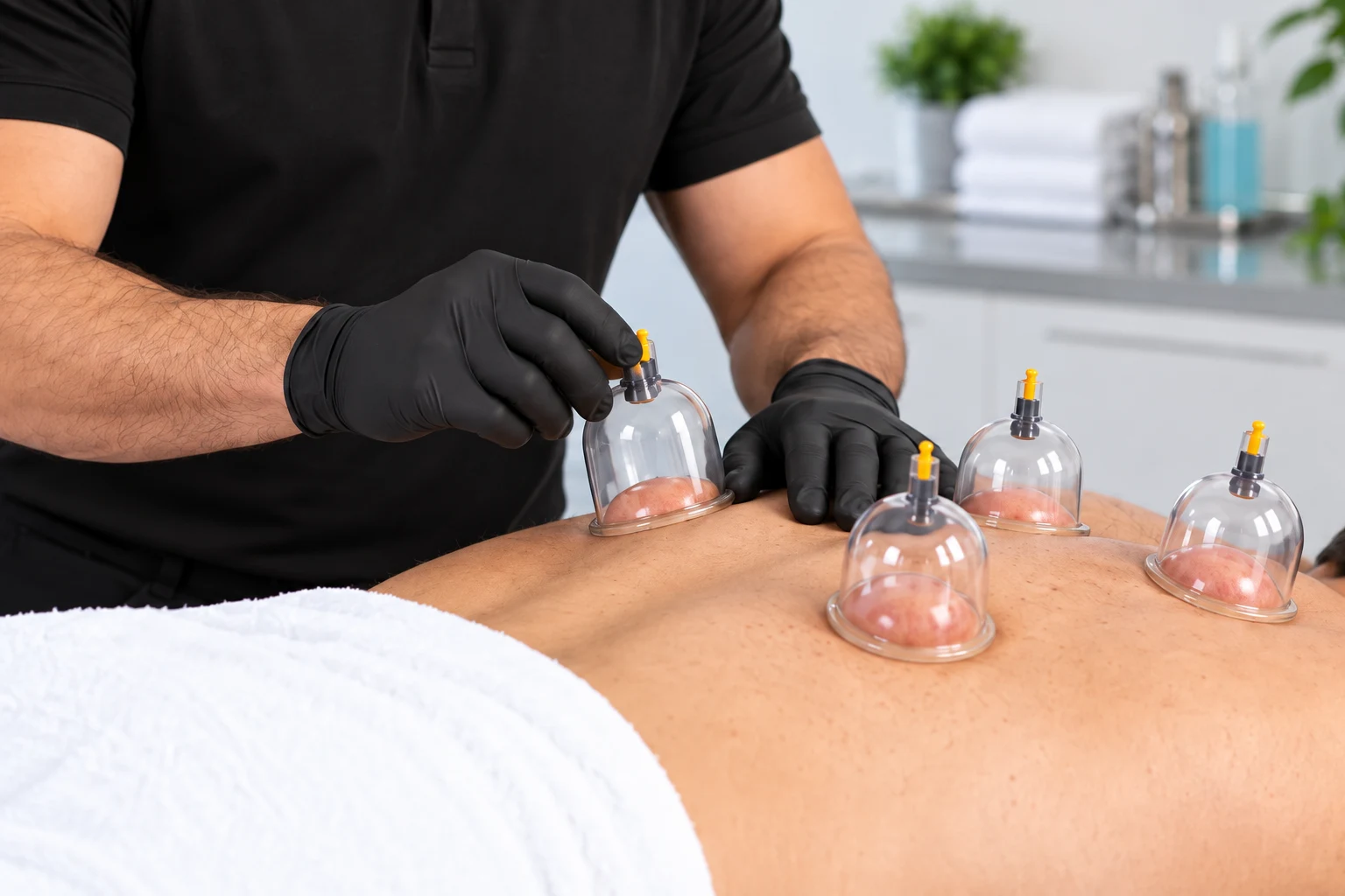 Hijama service at Prestons Injury Therapy